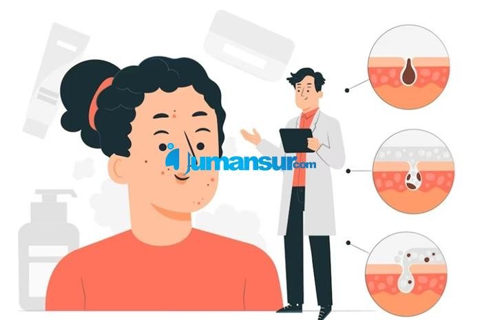 cara menghilangkan jerawat batu di pipi